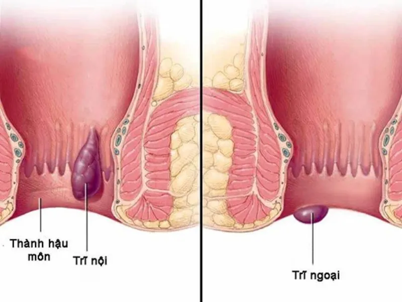 Không nên làm khi bị bệnh trĩ