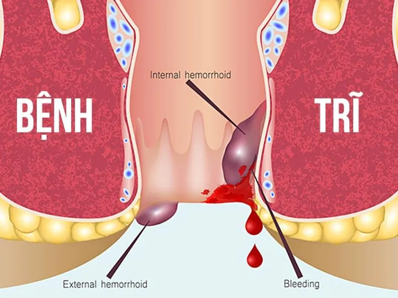 Các biện pháp chăm sóc để giúp bệnh trĩ tự hết