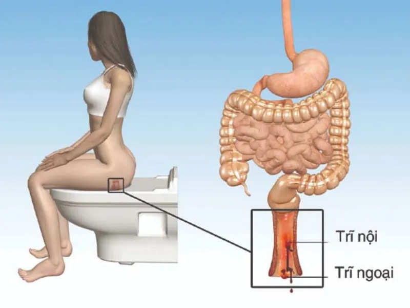 Triệu chứng của bệnh trĩ