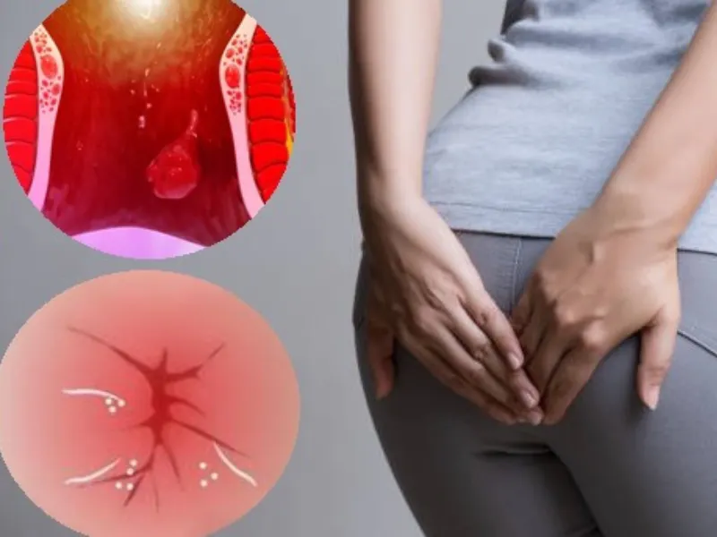 Bệnh trĩ: Tổng quan và phân loại
