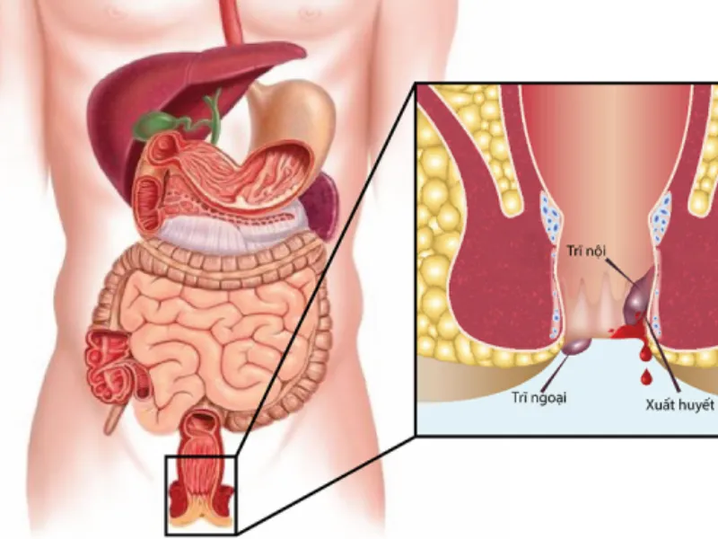 Nguy hiểm của bệnh trĩ nội độ 1