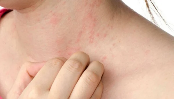 6-cc3a1ch-tre1bb8b-rc3b4m-se1baa3y-e1bb9f-ngc6b0e1bb9di-le1bb9bn-nhanh-vc3a0-de1baa5u-hie1bb87u-be1bb8b-rc3b4m-se1baa3y 6 Cách trị rôm sảy ở người lớn nhanh và dấu hiệu bị rôm sảy