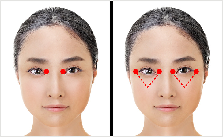Lấy mỡ mí mắt giúp đôi mắt to rõ và cải thiện mí lận hiệu quả