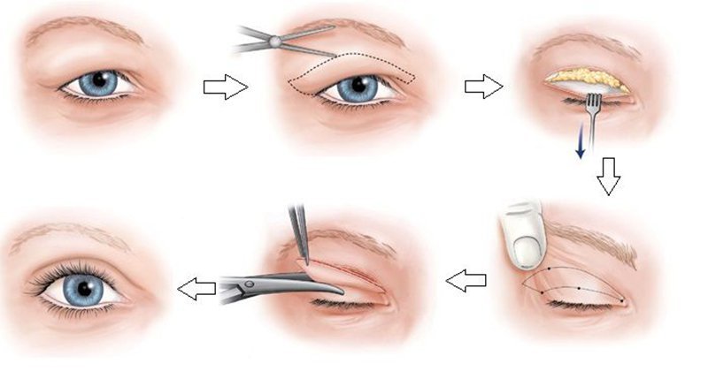Kỹ thuật cắt mí mắt an toàn, ít xâm lấn