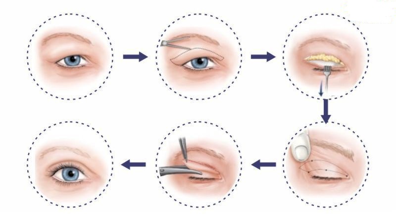 Kỹ thuật cắt mí mắt thực hiện khéo léo với độ chính xác cao