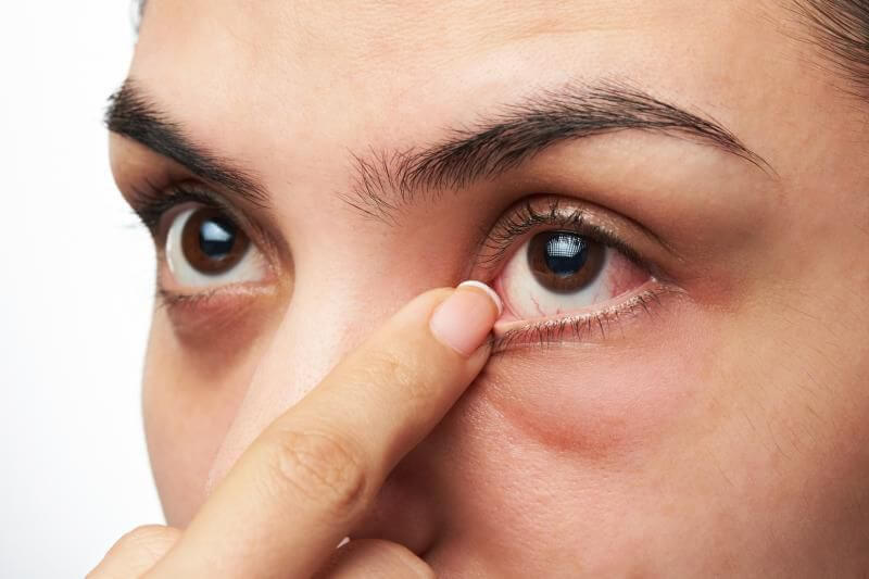 Người bị thường có cảm giác cộm khó chịu ở mắt