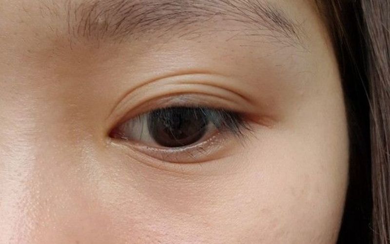 Mắt mí lót là như thế nào?