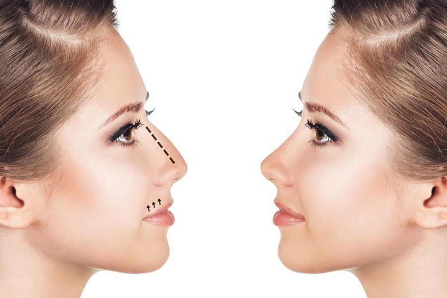 Phẫu thuật chỉnh mũi được nhiều người sử dụng