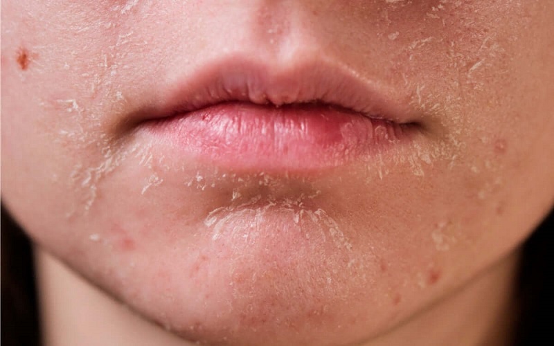 Làn da khô bị thiếu nước trở nên khô ráp, sần sùi, thậm chí là bong tróc, nứt nẻ