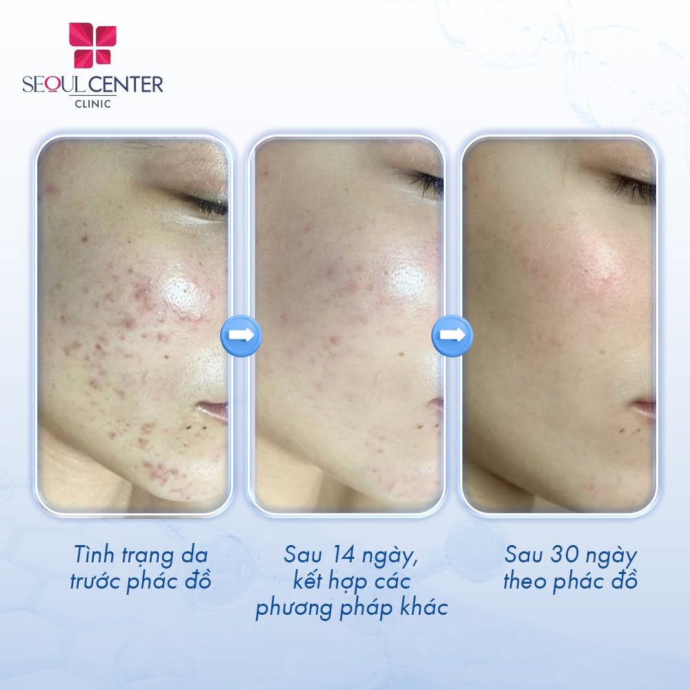 Công nghệ điều trị mụn Matrix tại Seoul Center Clinic sở hữu nhiều ưu điểm vượt trội