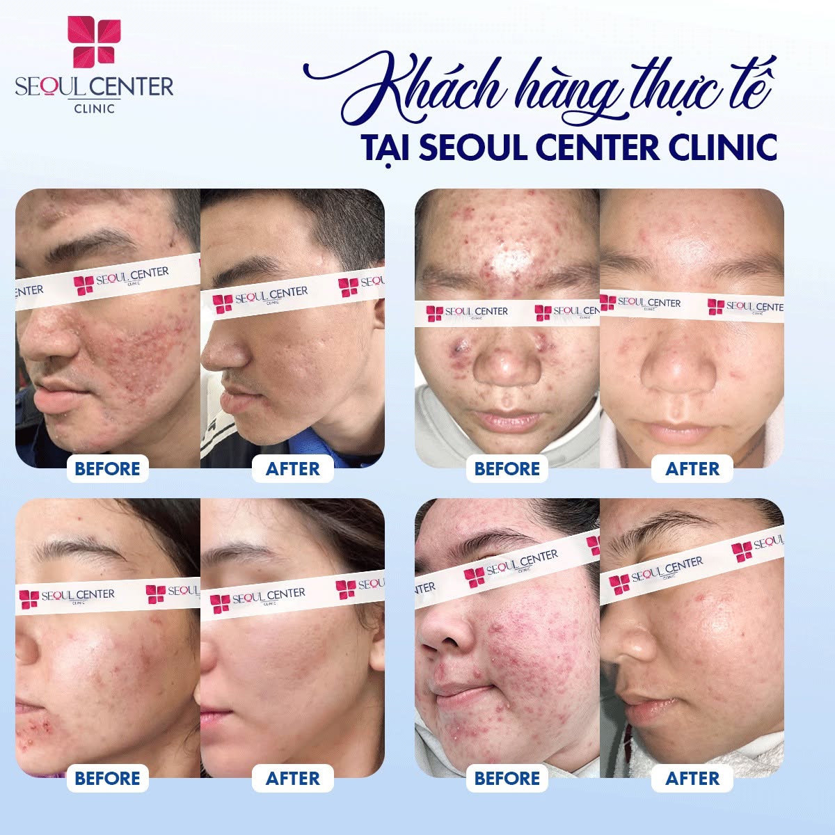 Trị mụn tại Seoul Center Clinic quý khách hàng sẽ an tâm về hiệu quả và an toàn