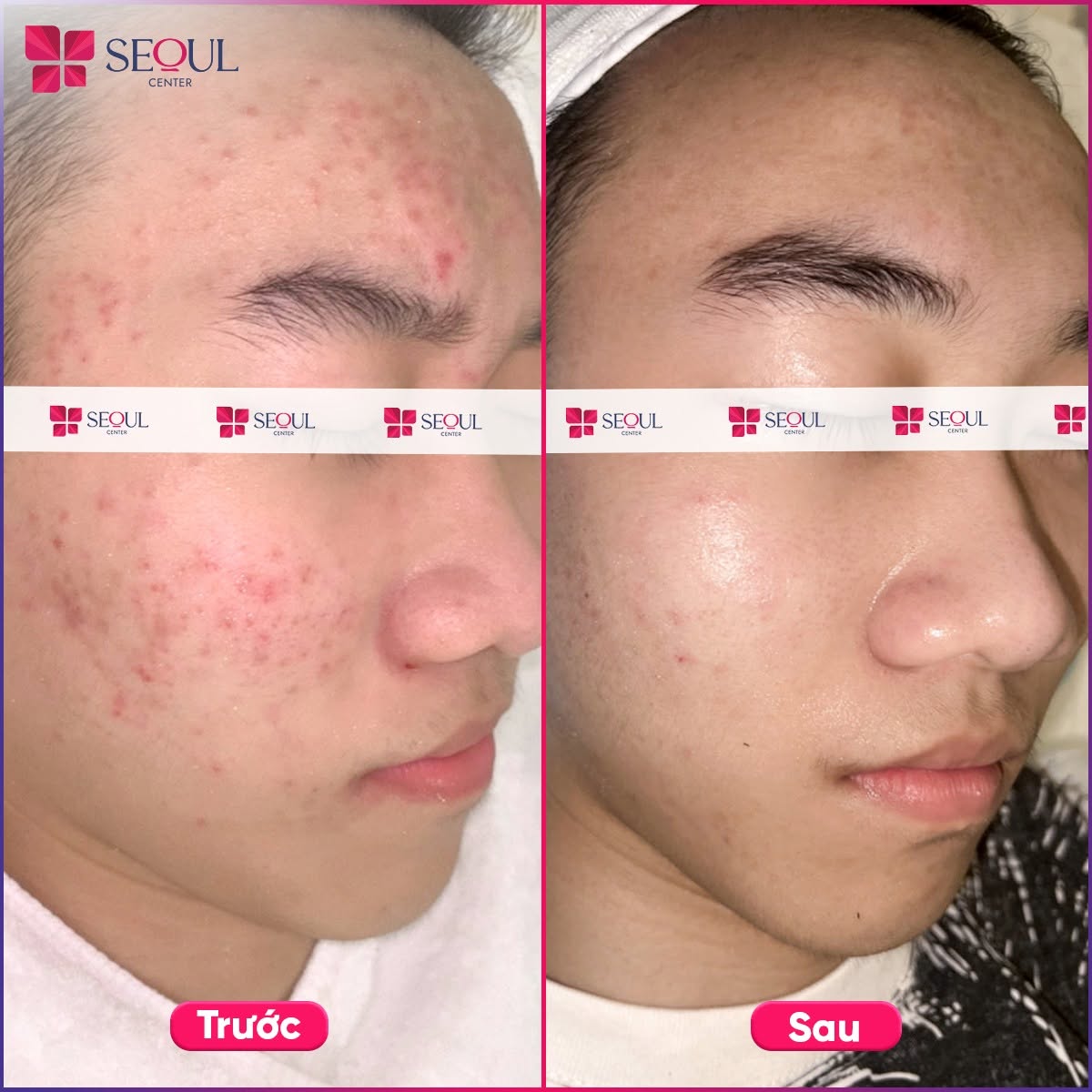 Hình ảnh trước và sau khi khách hàng điều trị mụn tại Seoul Center Clinic