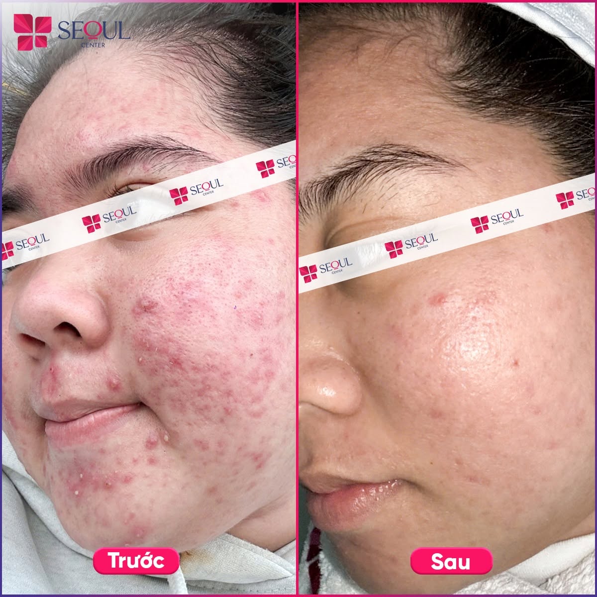 Hình ảnh tình trạng mụn khách hàng thuyên giảm đáng kể sau mỗi buổi điều trị tại Seoul Center Clinic