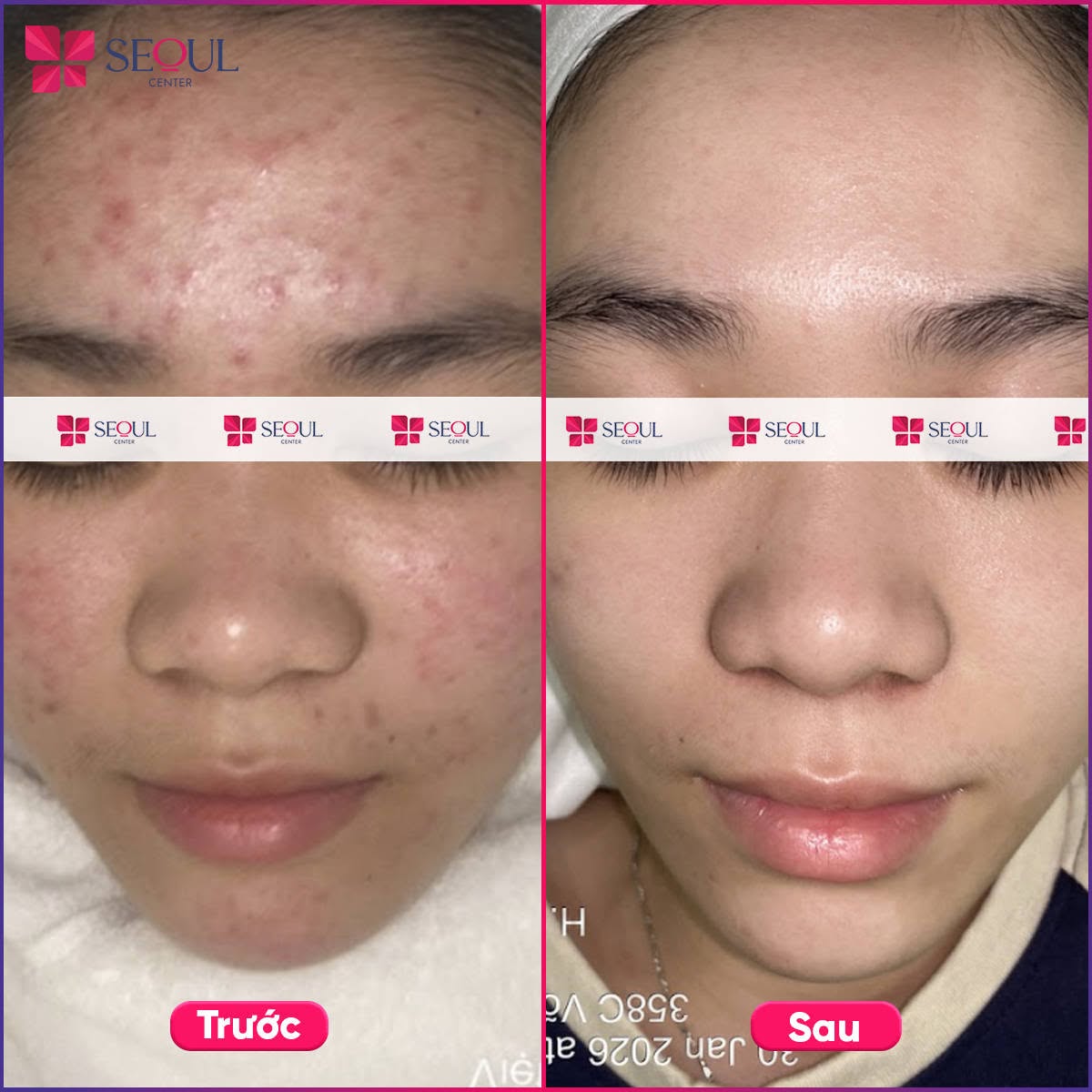 Da khách hàng trước và sau khi điều trị mụn tại Seoul Center Clinic hiệu quả rõ rệt