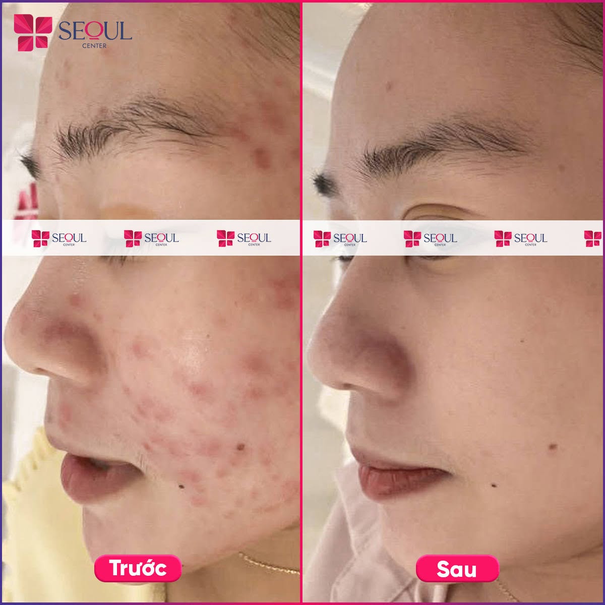 Tình trạng mụn của khách hàng đã hết hoàn toàn sau khi điều trị mụn tại Seoul Center Clinic