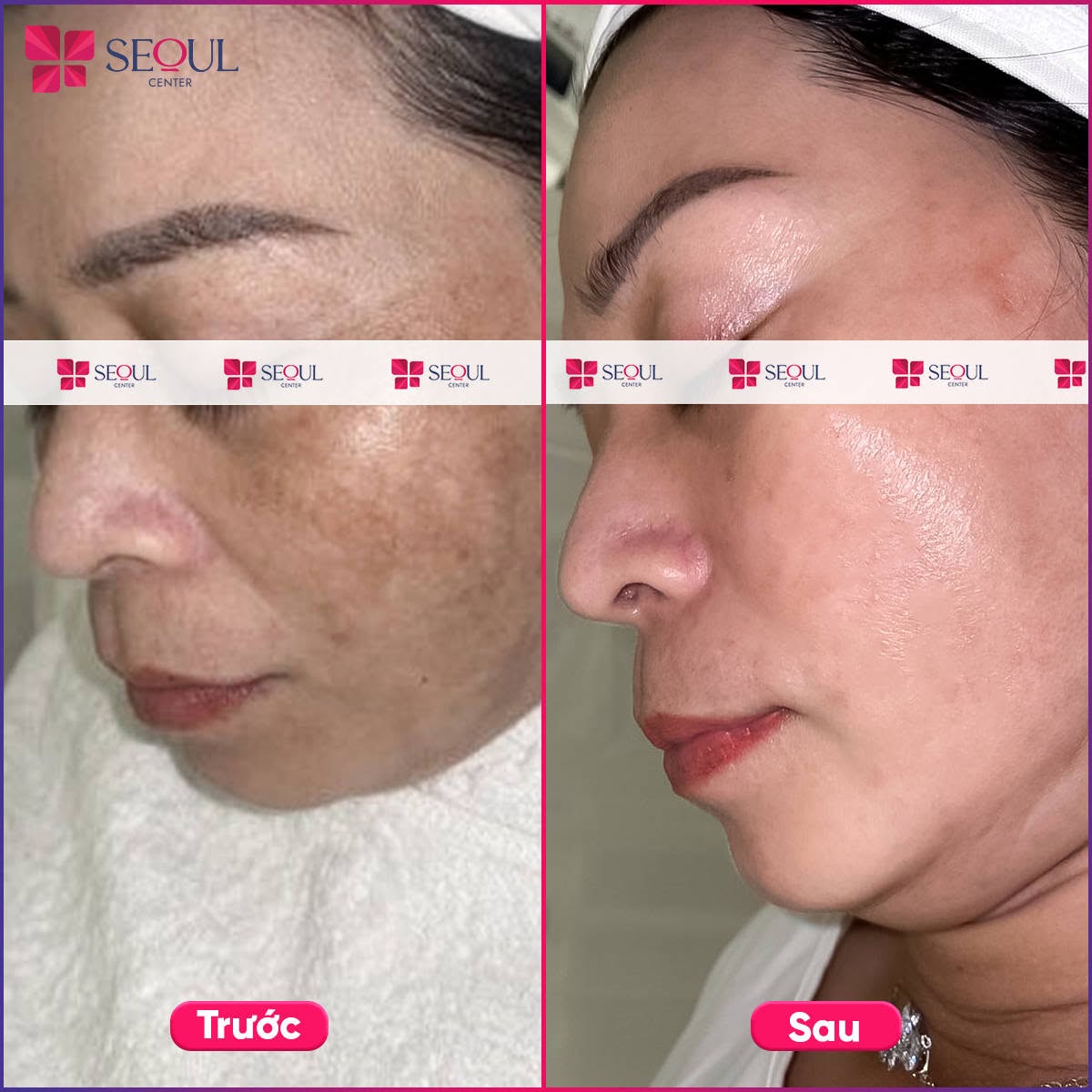 Làn da khách hàng trở nên sáng mịn, tươi tắn hơn sau điều trị nám Matrix tại Seoul Center Clinic