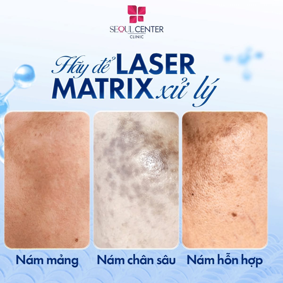 Công nghệ Laser Sắc Tố Matrix có thể trị nhiều loại nám khác nhau