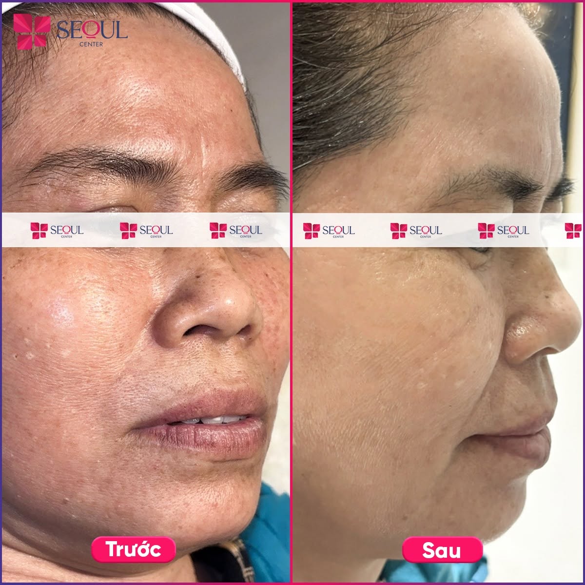 Sau liệu trình trị nám khách hàng sẽ thấy rõ hiệu quả 