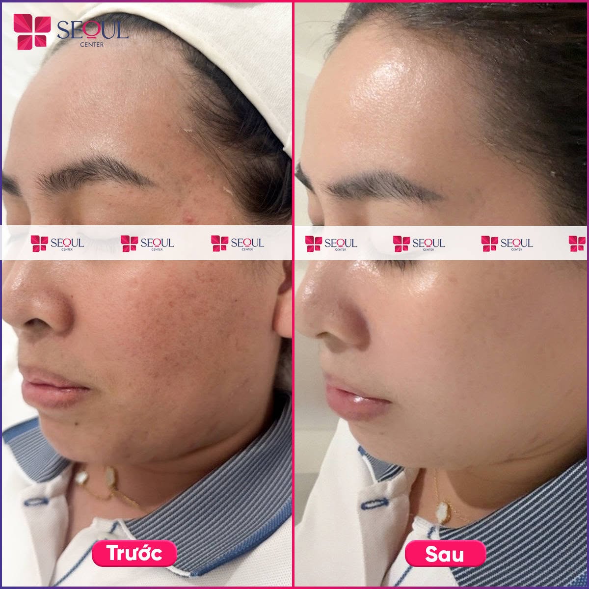 Hình ảnh trước và sau khi khách hàng điều trị nám Matrix tại Seoul Center Clinic