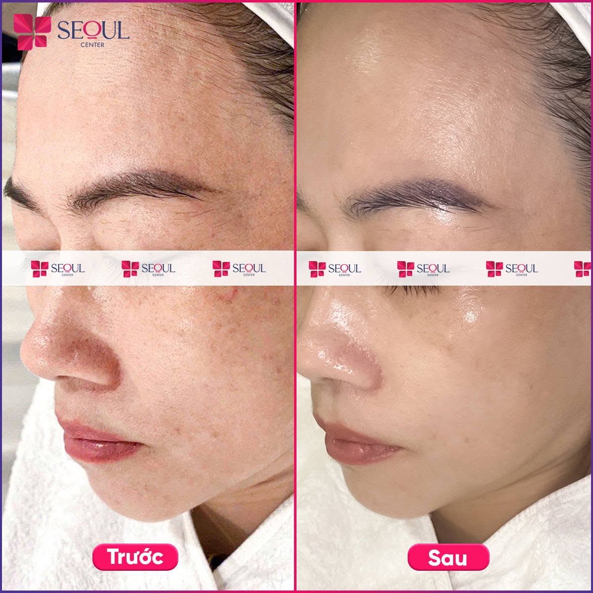 Da chị khách sáng mịn, căng bóng, đều màu và khỏe khoắn hơn sau điều trị nám Laser Sắc Tố Matrix