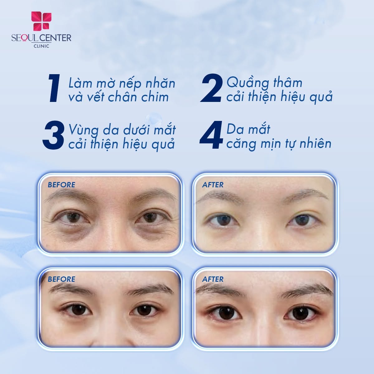 Khi tiêm Rejuran I tình trạng nếp nhăn, vết chân chim, quầng thâm ở mắt được cải thiện đáng kể