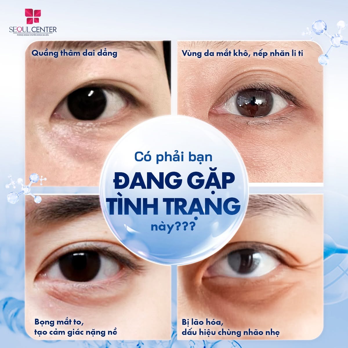Những ai có vùng quanh mắt bị lão hóa, vết chân chim, nếp nhăn li ti, da vùng mắt khô có thể áp dụng kỹ thuật tiêm meso Rejuran I để khắc phục