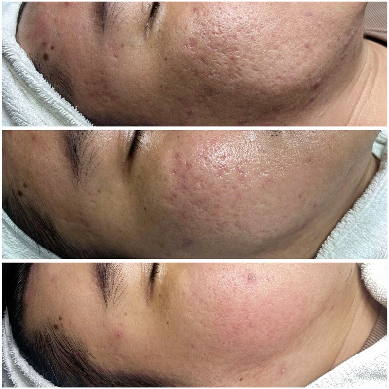 Phương pháp trị sẹo rỗ bằng Rejuran S không chỉ giúp trị sẹo dứt điểm mà hiệu quả bền vững