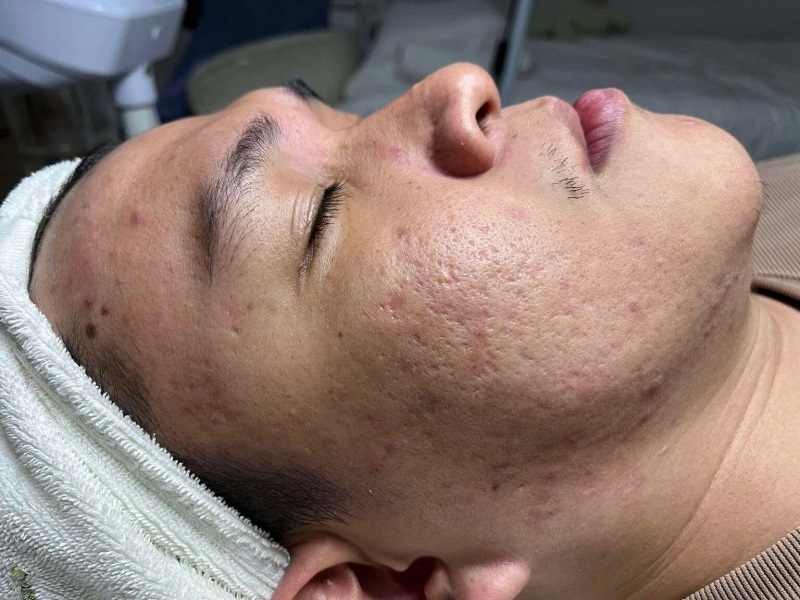 Những ai đang bị sẹo rỗ, sẹo lõm, da bị tổn thương do mụn có thể áp dụng liệu trình Rejuran S vào da