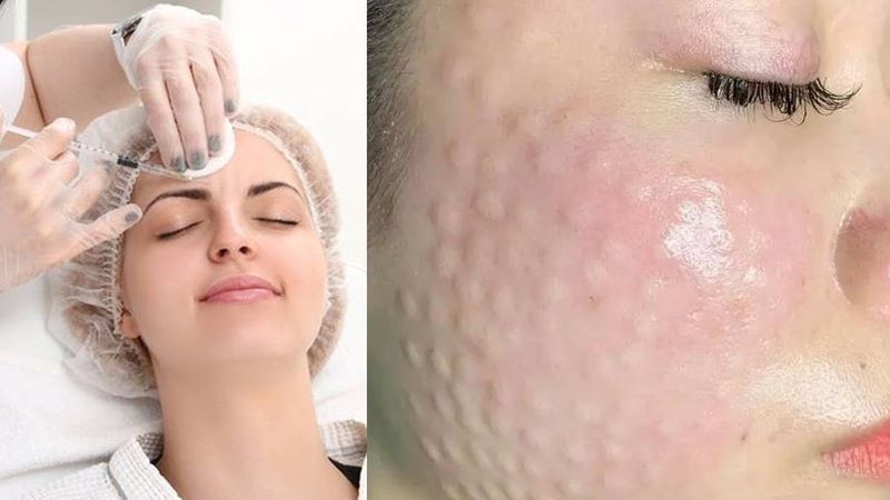 Liệu trình Rejuran Healer ứng dụng kỹ thuật tiêm vi điểm hoặc tiêm vi chạm hay tiêm B.A.P để đưa tinh chất vào da