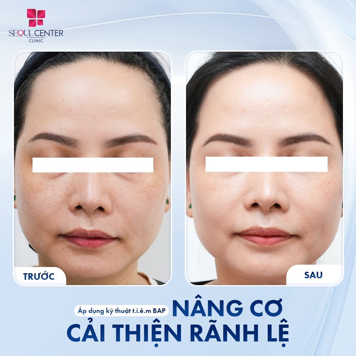 Làn da khách hàng cải thiện rõ rệt sau khi tiêm trẻ hóa Neo Xcelens