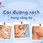 Các đường rạch trong căng da