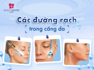 Các đường rạch trong căng da