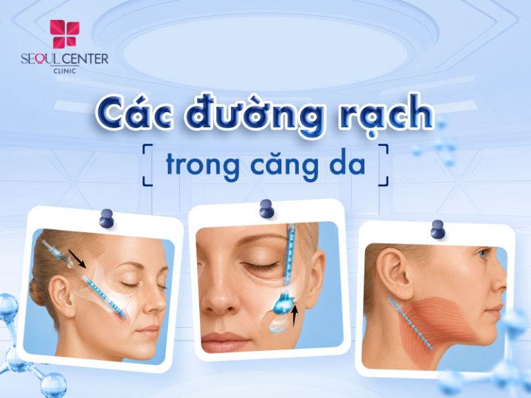 Các đường rạch trong căng da