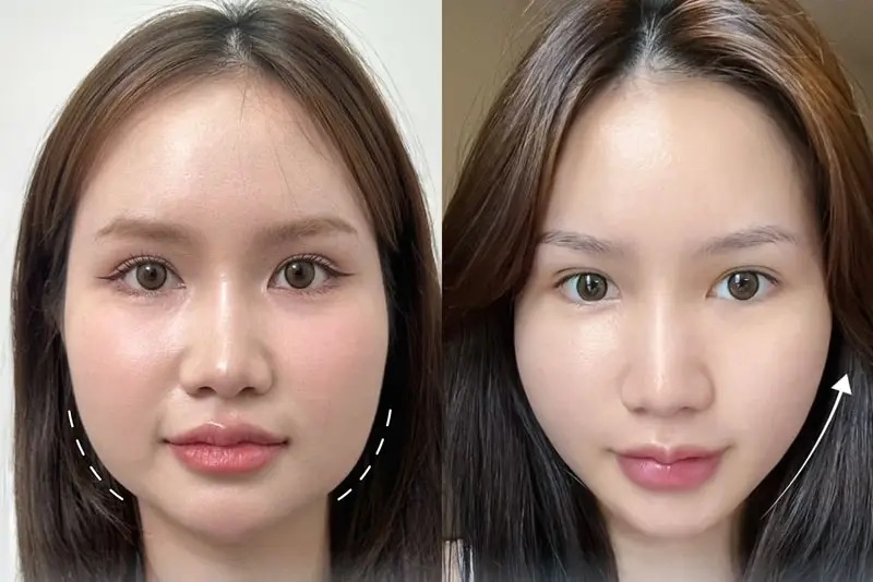 Sau khi tiêm Filler bạn cần chăm sóc vùng tiêm cẩn thận để sở hữu diện mạo Vline, thanh thoát
