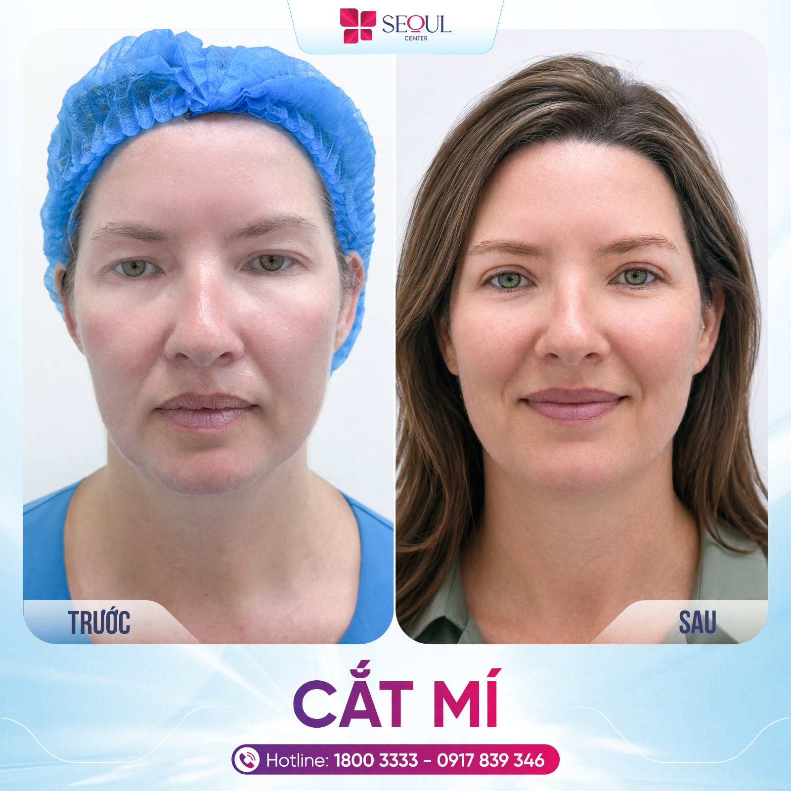 Mí mắt sau cắt bị tổn thương nên hãy chăm sóc theo hướng dẫn bác sĩ để nhanh lành và vào form ổn định