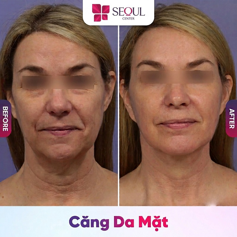 Sau căng da mặt, vùng thẩm mỹ bị tổn thương, cần được chăm sóc đặc biệt để phục hồi nhanh, mang lại kết quả trẻ hóa diện mạo toàn diện