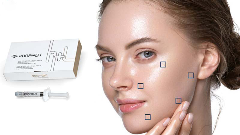 Sau khi được chăm sóc cẩn thận, làn da tiêm Profhilo sẽ được cấp ẩm, căng mịn, săn chắc, mờ nếp nhăn, diện mạo trẻ hóa bất ngờ
