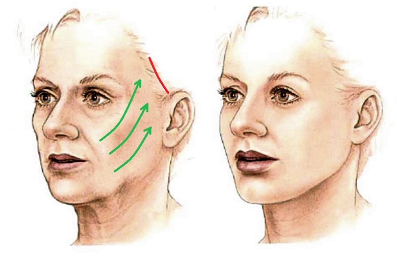 Thị trường dịch vụ căng da Midface tại Việt Nam đang sự tăng trưởng mạnh