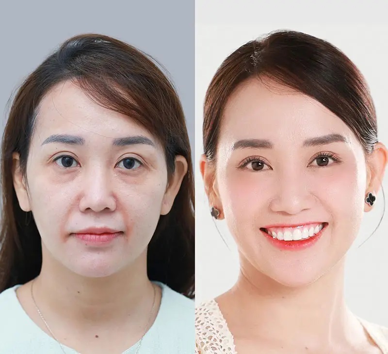 Mỗi phương pháp căng da mặt sẽ có thời gian duy trì hiệu quả khác nhau