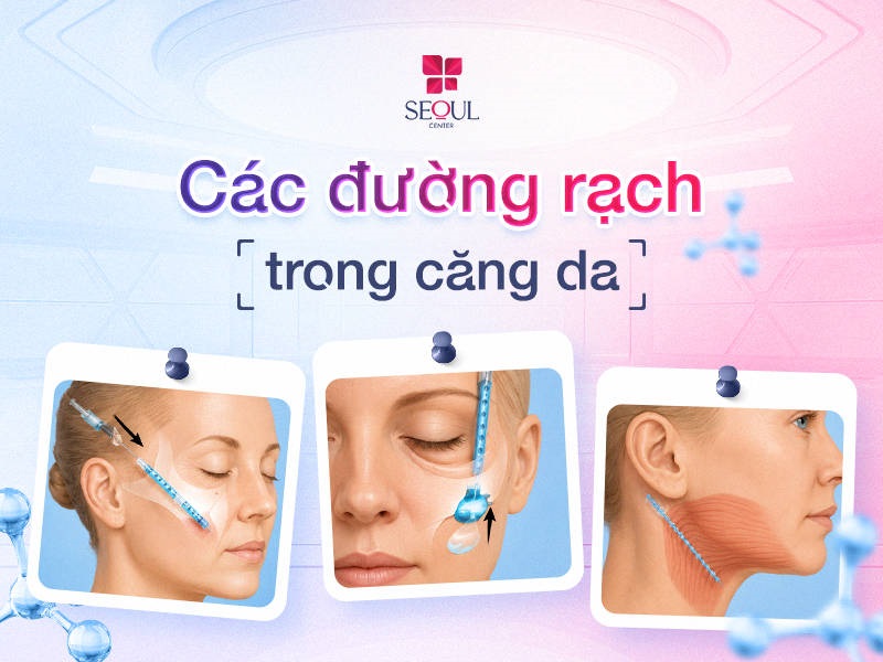 Các đường rạch phổ biến trong căng da