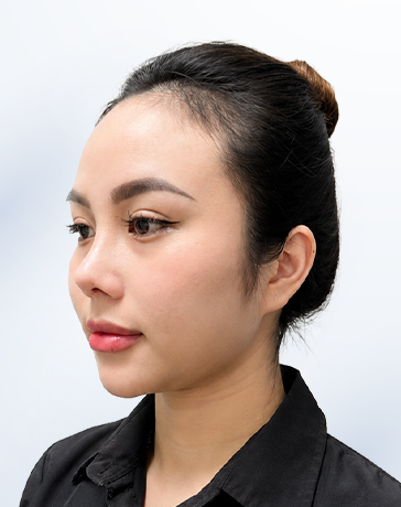 Kim Ngân sau liệu trình