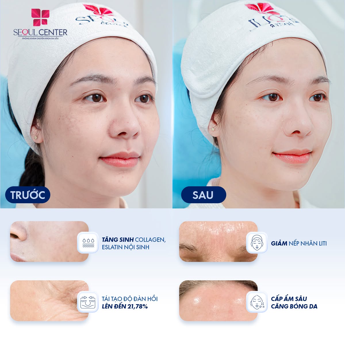 Tiêm Rejuran sở hữu nhiều ưu điểm vượt trội mang lại nhiều công dụng tốt cho da