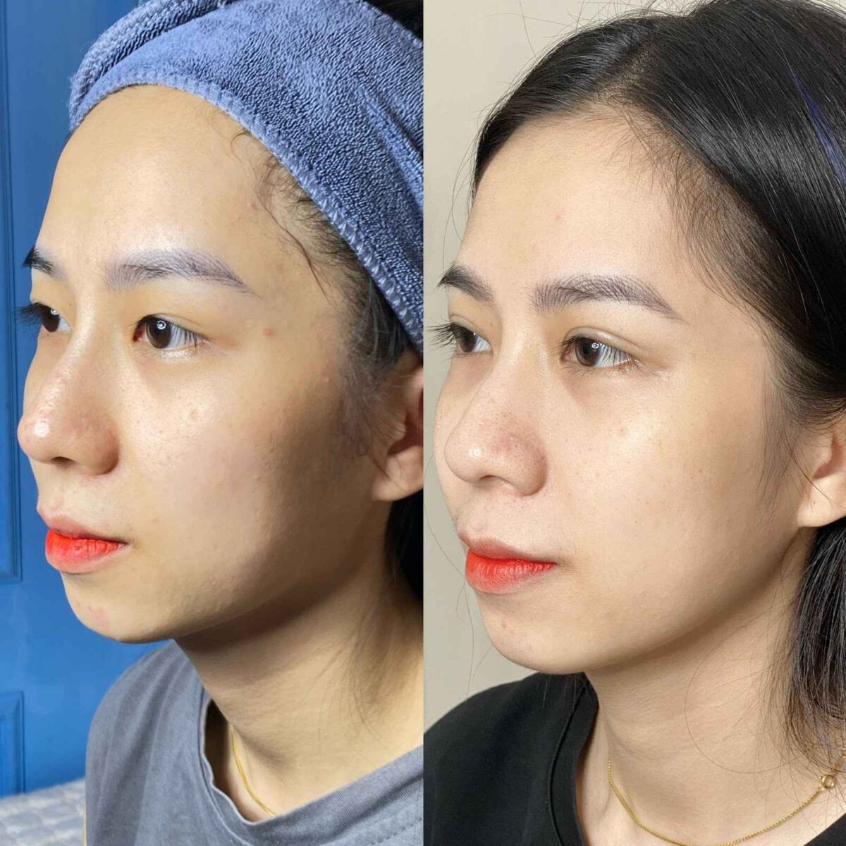 Tiêm Juvederm kết hợp với sản phẩm khác sẽ mang đến hiệu quả trẻ hóa làn da vượt trội hơn