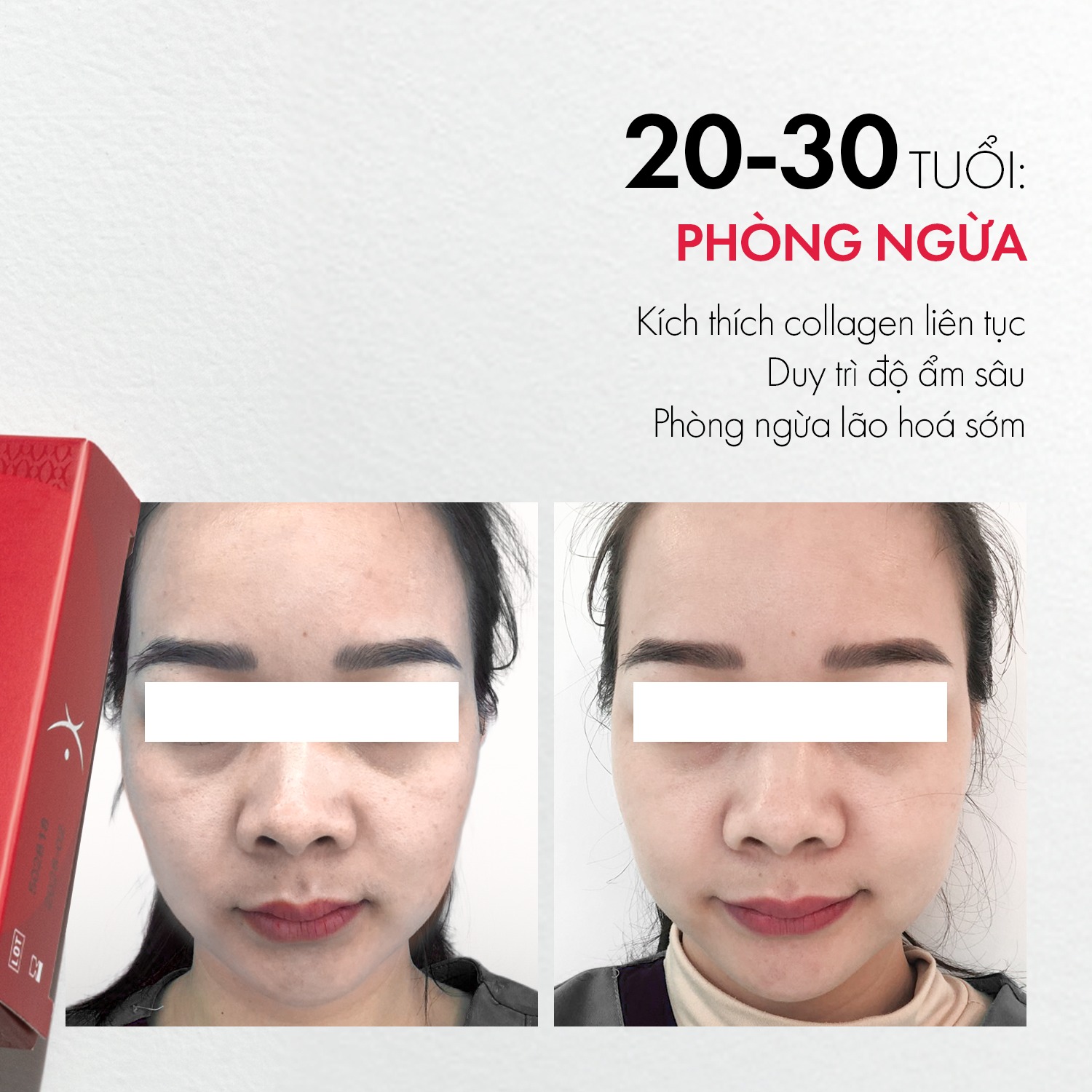 Tiêm DoublyX Evo giúp kích thích collagen tăng sinh, tăng thể tích mỡ vùng mặt, căng bóng da, làm mịn và tái tạo da vùng sẹo, đặc biệt ngăn ngừa lão hóa sớm