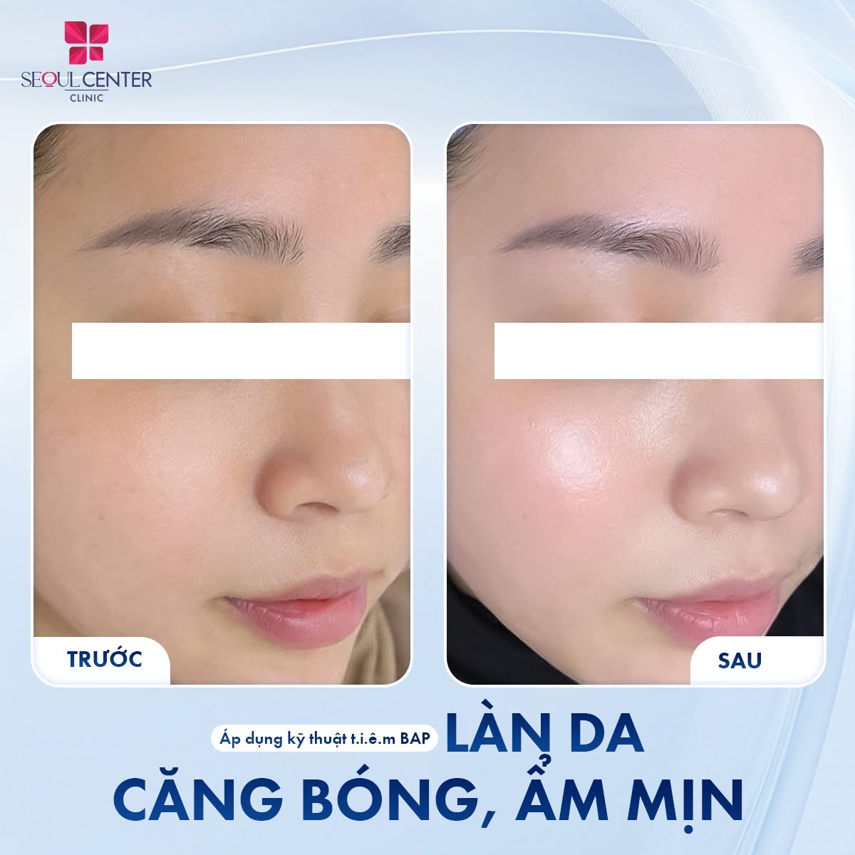 Tiêm Genyal Genyalift bằng kỹ thuật B.A.P giúp da mịn màng, căng bóng, khỏe khoắn, đều màu hơn