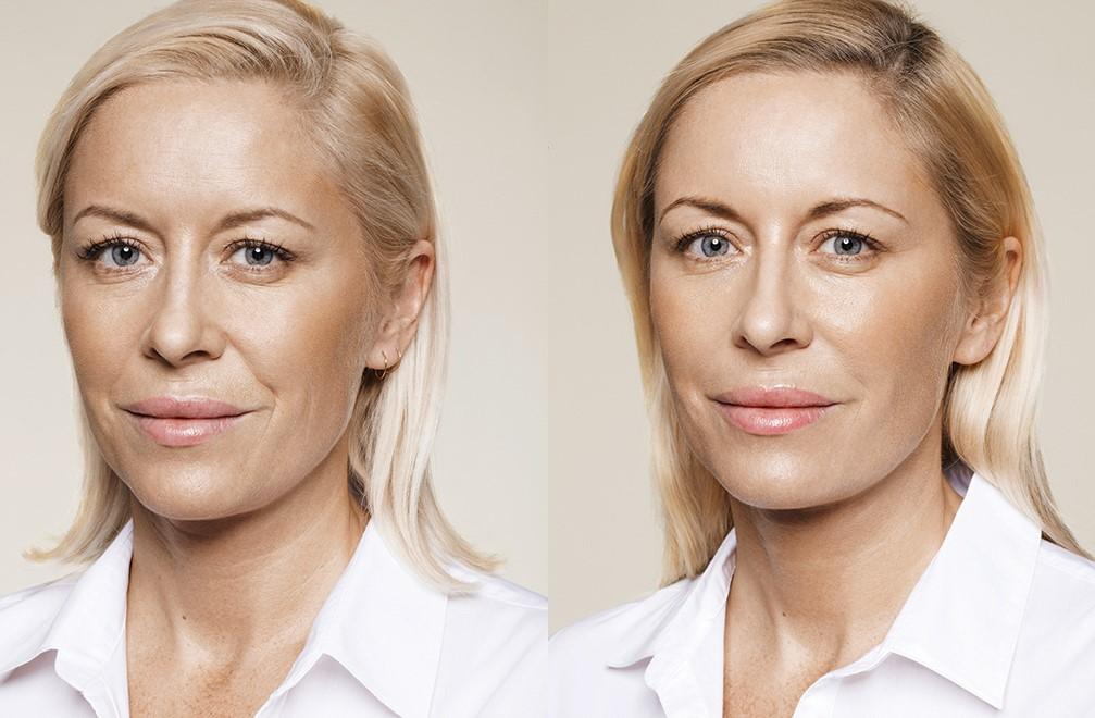 Tiêm Restylane Vital Light giúp da sáng, giảm nếp nhăn, da mịn màng, khỏe khoắn hơn  