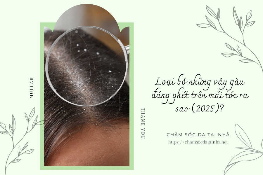 Loại bỏ những vảy gàu đáng ghét trên mái tóc ra sao (2025)