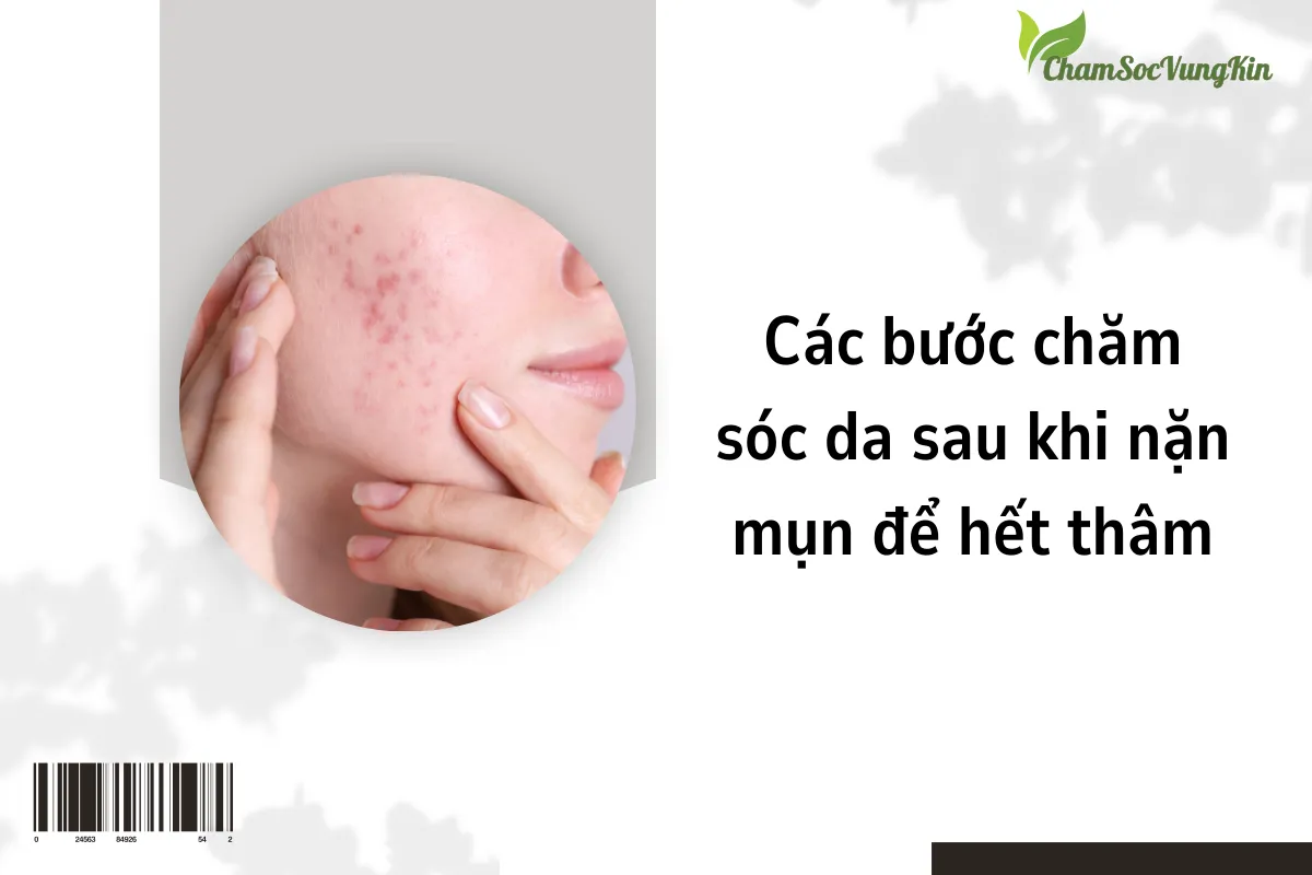 Các bước chăm sóc da sau khi nặn mụn để hết thâm