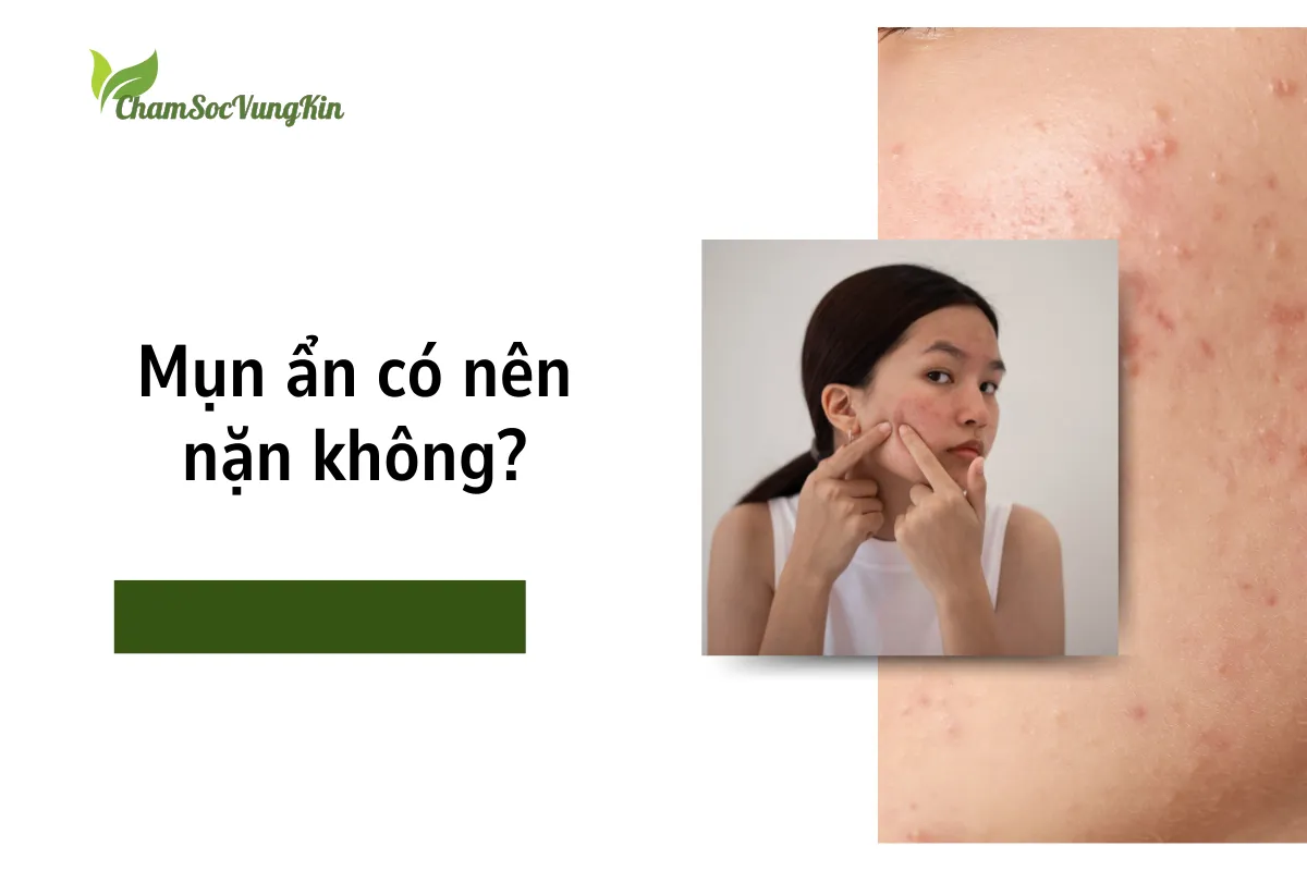 Mụn ẩn có nên nặn không?