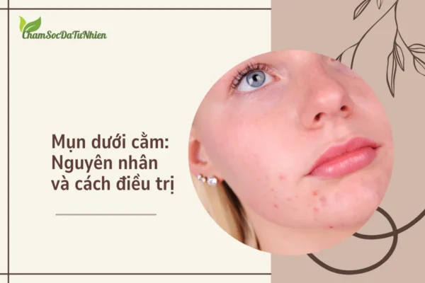 Mụn dưới cằm Nguyên nhân và cách điều trị (1)